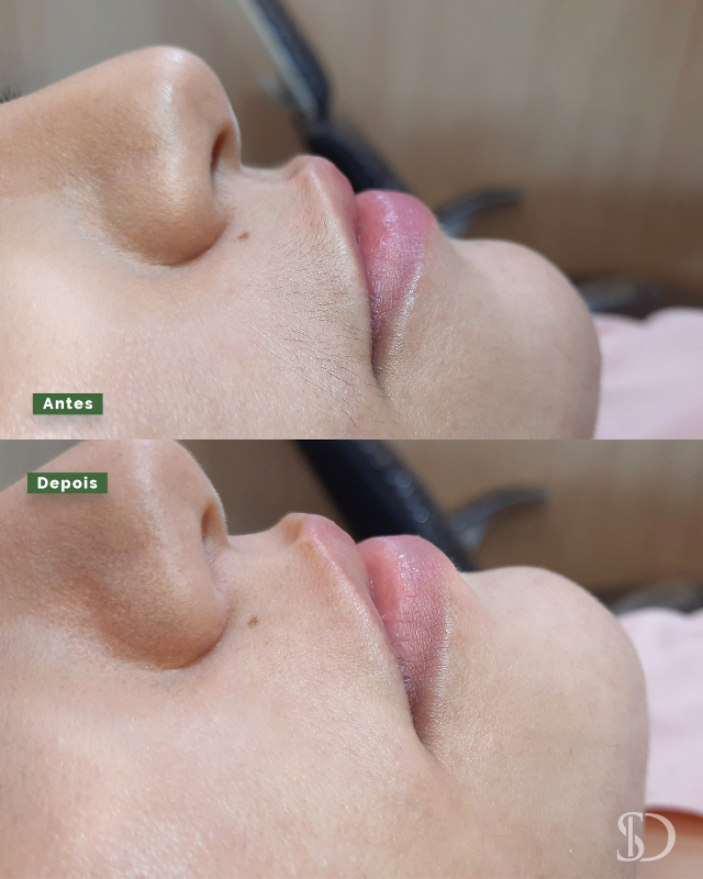 Epilação facial com linhas